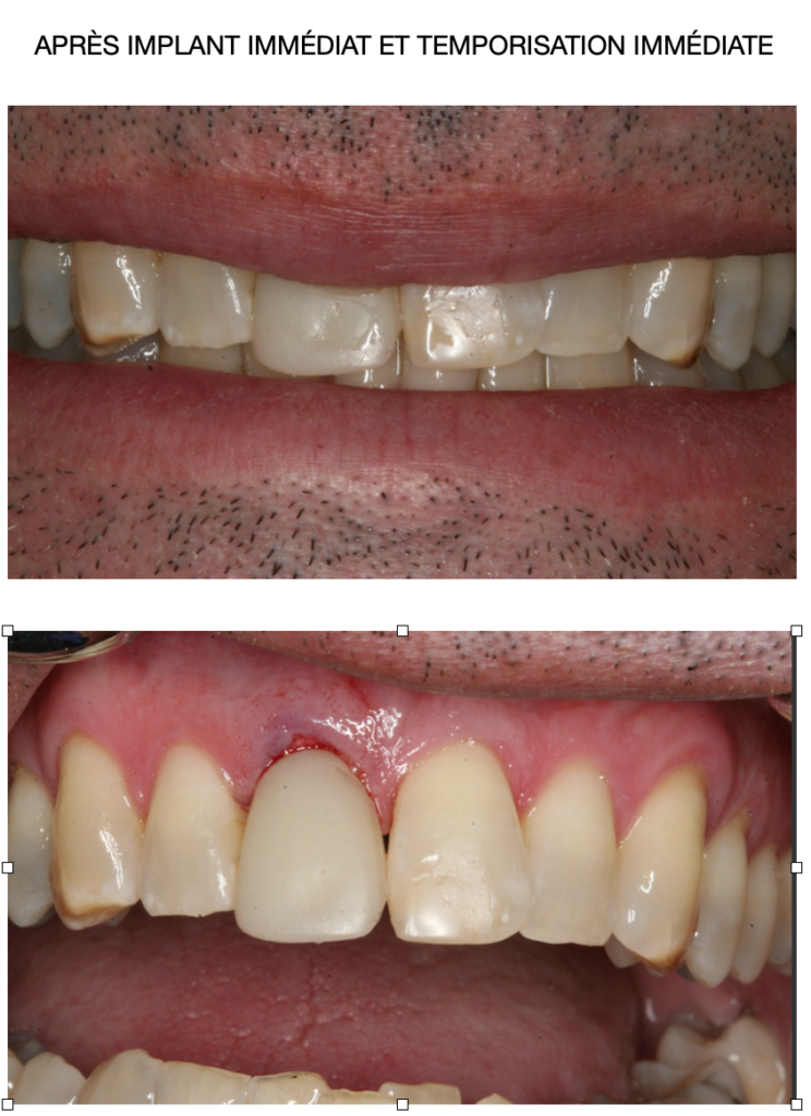 Les implants dentaires Parodontistes Chelsea